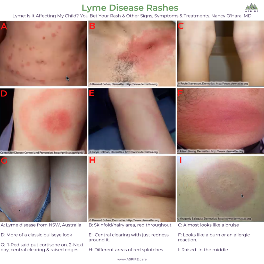 Lyme Disease ERM rash